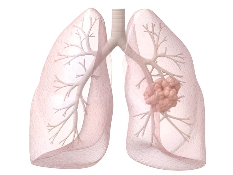 AstraZeneca Halts Phase III eVOLVE-Lung02 Trial of Volrustomig in Advanced Lung Cancer