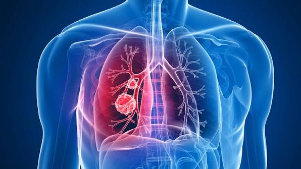 Enhertu Shows Better Results Than Standard Treatment in Lung Cancer Trial